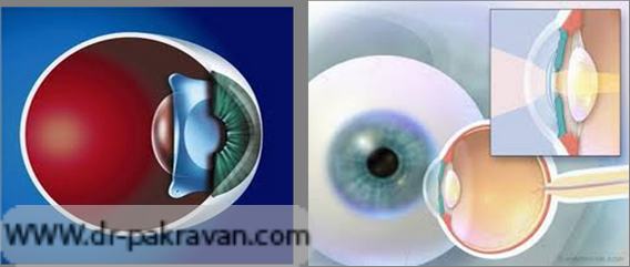لنزهای داخل چشمی یا در جلوی عنبیه (راست) و یا در جلوی عدسی طبیعی (چپ) قرار داده می‎شود.